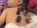 艾灸養生保健 治療各種亞健康 微信htte903761991