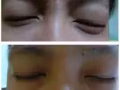 田七去除眼袋！去除黑眼圈！就是這麼簡單 【三分钟见效】微信：3214985723
