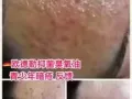 祛痘祛痘，天然的臭氧油，带你祛痘不留痕