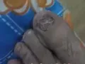 修正氧趣臭氧油治疗灰指甲，一瓶就见效