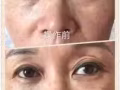 不管你是有眼袋、眼纹、上眼皮凹陷还是颈项纹，不动刀，单纯仪器做可维持10年左右[