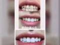 美牙仪