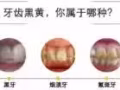 你需要的美牙仪