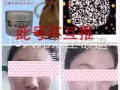 苗方祛痘膏
