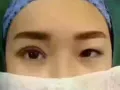 埋线双眼皮