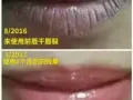 修复受损唇部或者纹过唇的