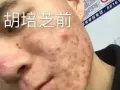 祛痘交给我美丽留给你