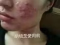 15天见效不反复的祛痘膏