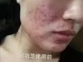 15天见效不反复的祛痘膏