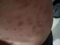 牛皮癬特效中藥，我自己在中國看的中醫藥買一個月，現在15天病好了多15天藥，有需