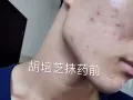 纯中草药祛痘七天见效