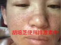 纯中草药祛痘七天见效