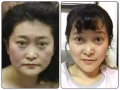 徒手整骨小颜术见证奇迹
