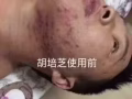 祛痘不反弹