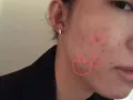 祛痘粉刺