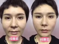 最新科技 水除皱 红细胞面部激活 瘦脸 瘦腿瘦肩 小脸针 水光针 太阳穴下巴