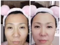 最新科技 水除皱 红细胞面部激活 瘦脸 瘦腿瘦肩 小脸针 水光针 太阳穴下巴