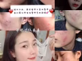 莫小在纯植物祛痘膏(一套四个产品）