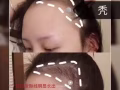Alilang 美容院 （溶脂+生发 包效果）