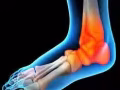 除痛： 頸 肩 腰 胠 踝 肛痔疼痛 Pain Free