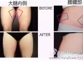 酷塑--冷冻减脂
