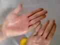 Eczema cream ,dry skin ,burn skin