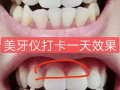 想擁有一口大白牙的點進來 無效退款