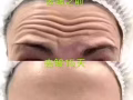 去皱，瘦脸，淡滨尼，小雪