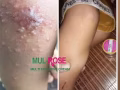 Eczema, rash, dryness, itchy skin,