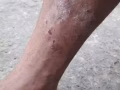 Eczema, rash, dryness, itchy skin,
