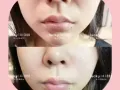 微整 买就送 瘦脸.瘦腿.瘦肩.小脸针.水光针填充下巴