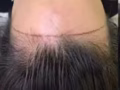 韩式半永久纹发际线 男女都可以做