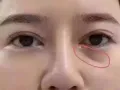 微整大优惠