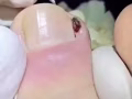 专业脚底按摩 专治甲沟炎 指甲往肉长