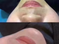 美容，微整，水光针，项目大促销