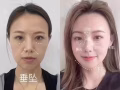 美容，微整，水光针，项目大促销