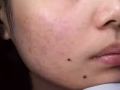 痘痘的克星