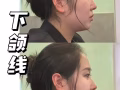 Face lifting/ 去除双下巴/除去脸上肥肉