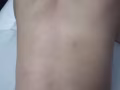 脊柱侧弯 骨盆不正  圆肩陀背矫形
