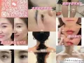 眼角纹 眼下纹 鼻背纹 额头纹 川字纹 瘦脸 瘦肩 瘦腿！溶脂、溶双下巴、泪沟、嘟嘟唇，下巴填充！扫码咨询🌹