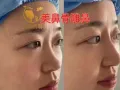 【可上门】美鼻骨雕鼻打造妈生鼻丰鼻子操作几分钟随做随走