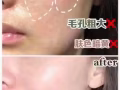 丽丝塔小金盒水光中的爱马仕！专业机打水光针！