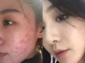专业祛痘｀红血丝｀痤疮，无效不收取任何费用
